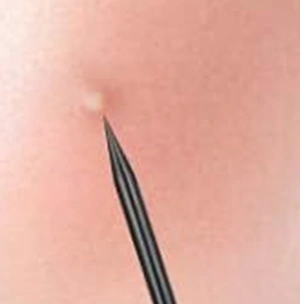 STEEL BLACKHEAD REMOVER WITH POINTED PIN